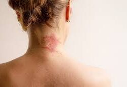 Allergic Inflammation