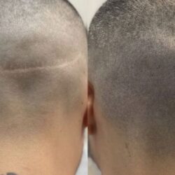 Scar Camouflage Tattoo