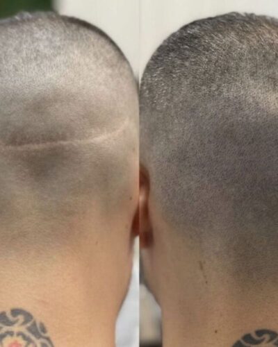 Scar Camouflage Tattoo Scar Camouflage Tattoo