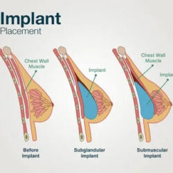 Breast Implant Surgery in Delhi for Enhanced Curves