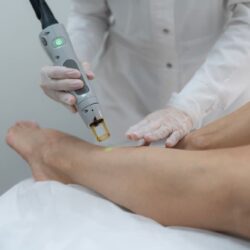 Laser Hair Removal for Dark Skin in Dubai (1)