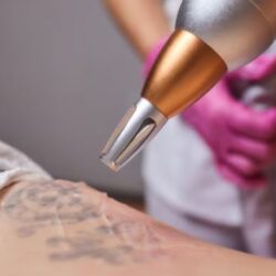 Glycolic Acid Tattoo Removal