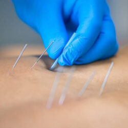 Dry Needling Services