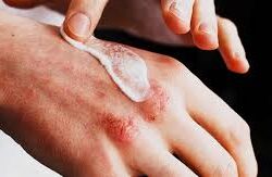 Chronic urticaria research
