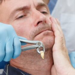 Tooth Extraction Services
