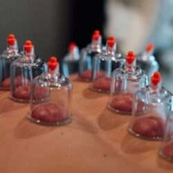 Cupping Therapy Services