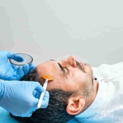 BestChemicalPeelTreatmentinBengaluru