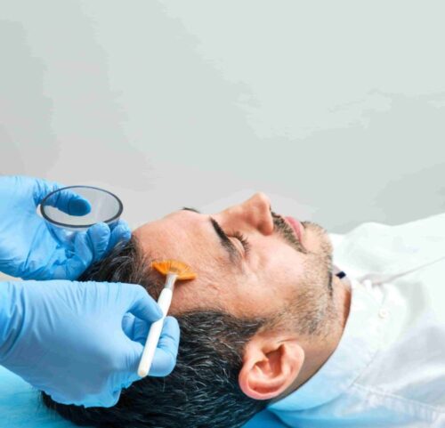 BestChemicalPeelTreatmentinBengaluru BestChemicalPeelTreatmentinBengaluru