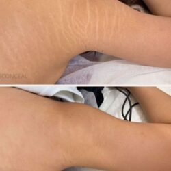 Scar Camouflage Tattoo (1)