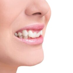 Crooked-Teeth