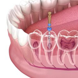 root-canal-treatment