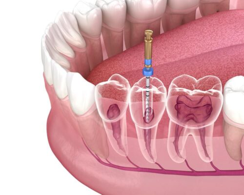 root-canal-treatment root-canal-treatment