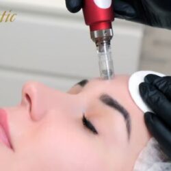 Best Potenza Microneedling Near Me
