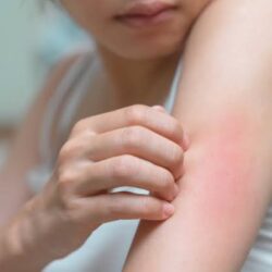Chronic urticaria research