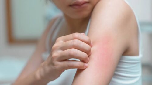 Chronic urticaria research Chronic urticaria research