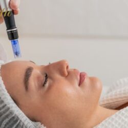 Potenza Microneedling in Riverside