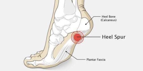 Calcaneal Spur Treatment in Gurgaon Calcaneal Spur Treatment in Gurgaon