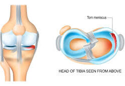 Meniscus Injury in Gurgaon