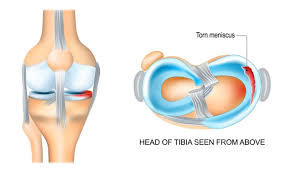 Meniscus Injury in Gurgaon Meniscus Injury in Gurgaon