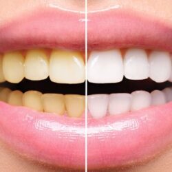 Laser Teeth Whitening