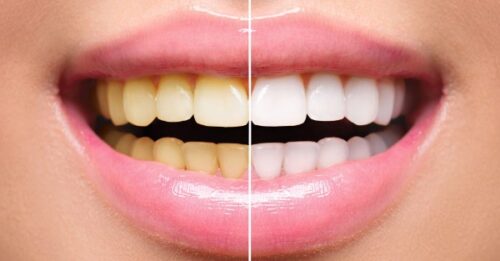 Laser Teeth Whitening Laser Teeth Whitening