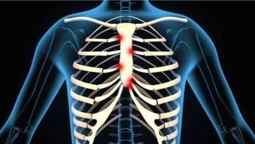 Costochondritis Physiotherapy Treatment Costochondritis Physiotherapy Treatment