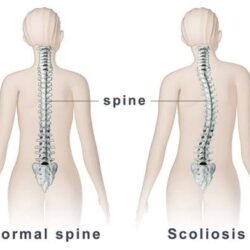 Scoliosis Treatment in Gurgaon
