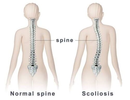 Scoliosis Treatment in Gurgaon Scoliosis Treatment in Gurgaon