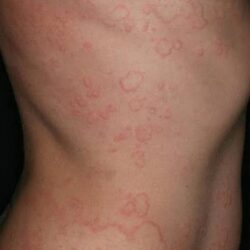 Chronic urticaria research