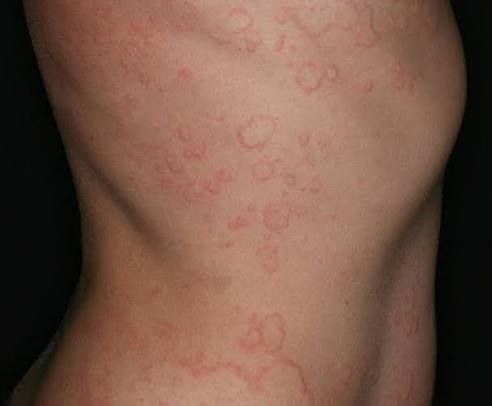 Chronic urticaria research Chronic urticaria research