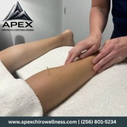 Dry Needling