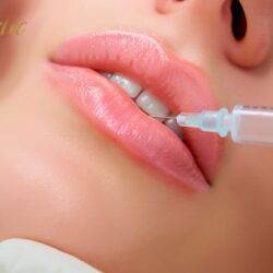 Smile Naturally with Lip Fillers Riverside