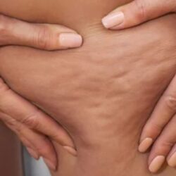 Cellulite Reduction