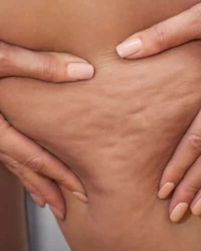 Cellulite Reduction Cellulite Reduction