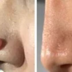 5676_Skin Tag
