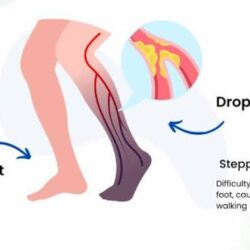 Foot Drop Treatment in Gurgaon
