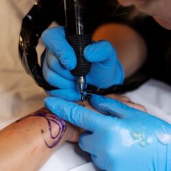 Saline Removal Tattoo