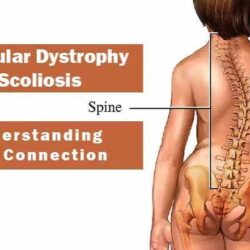 Muscular Dystrophy Treatment