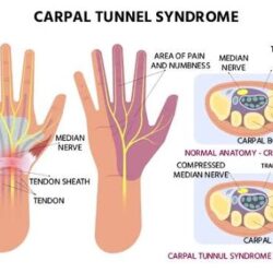 Carpal Tunnel Syndrome Treatments
