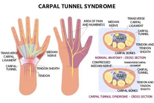 Carpal Tunnel Syndrome Treatments Carpal Tunnel Syndrome Treatments