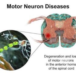 Motor Neuron Disease Treatment