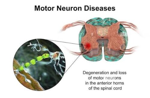 Motor Neuron Disease Treatment Motor Neuron Disease Treatment