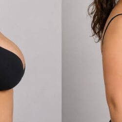 breast reduction Dubai
