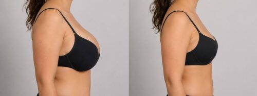 breast reduction Dubai breast reduction Dubai