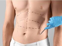liposuction in dubai .