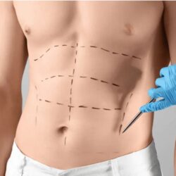 liposuction in dubai.