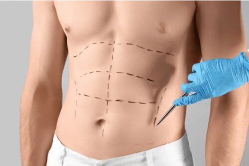 liposuction in dubai. liposuction in dubai.