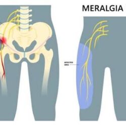Meralgia Paresthetica Treatment