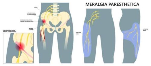 Meralgia Paresthetica Treatment Meralgia Paresthetica Treatment