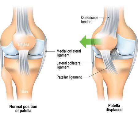 Chondromalacia Patella Treatment Chondromalacia Patella Treatment